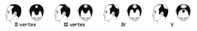 国内第Ⅱ／Ⅲ相二重盲検比較試験で対象となった頭頂部脱毛タイプ